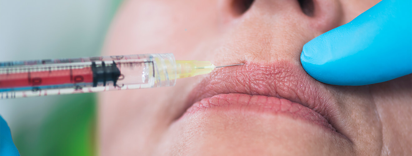 Lip Flip Botox Vancouver